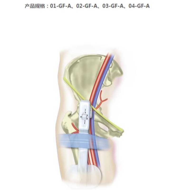 Goldfinger Electronic Femoral Hemostasis Compression Device