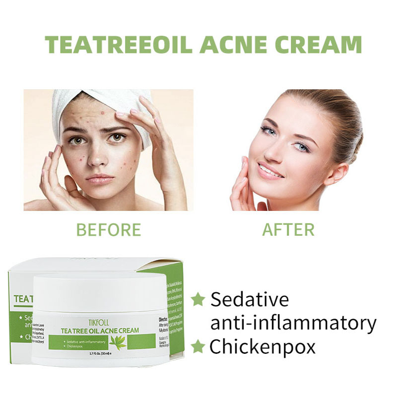 Crema acne dell'olio dell'albero del tè