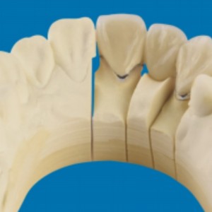 Metallo-denti in porcellana